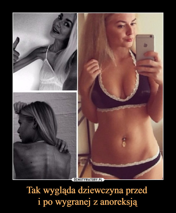 Tak wygląda dziewczyna przed i po wygranej z anoreksją –  